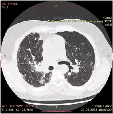 Lung fibrosis in sarcoidosis. Is there a place for antifibrotics?